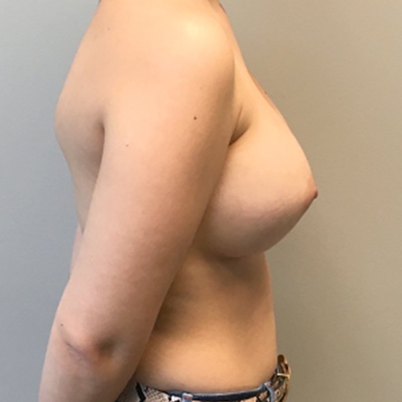 Breast Augmentation 05