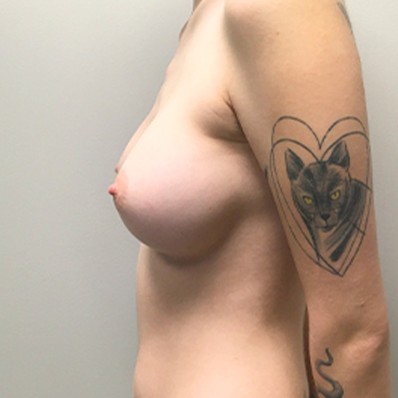 Breast Augmentation 05