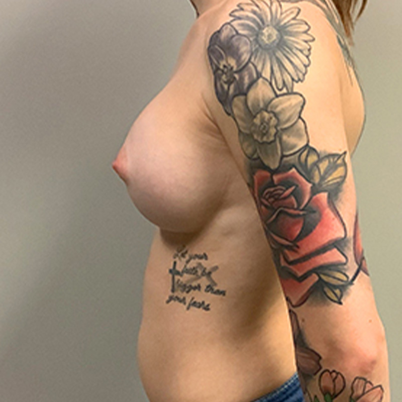 Breast Augmentation 05