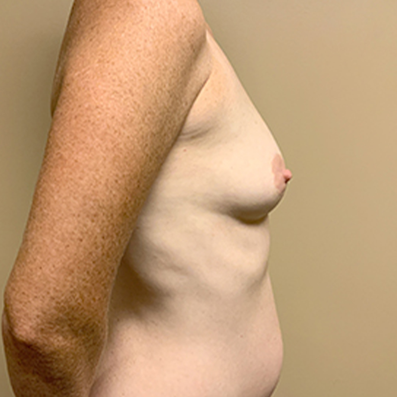 Breast Augmentation 09