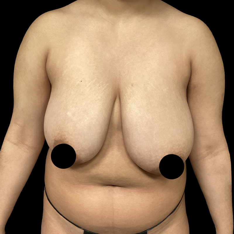 Breast Lift With Reduction 01