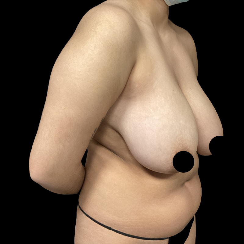 Breast Lift With Reduction 05