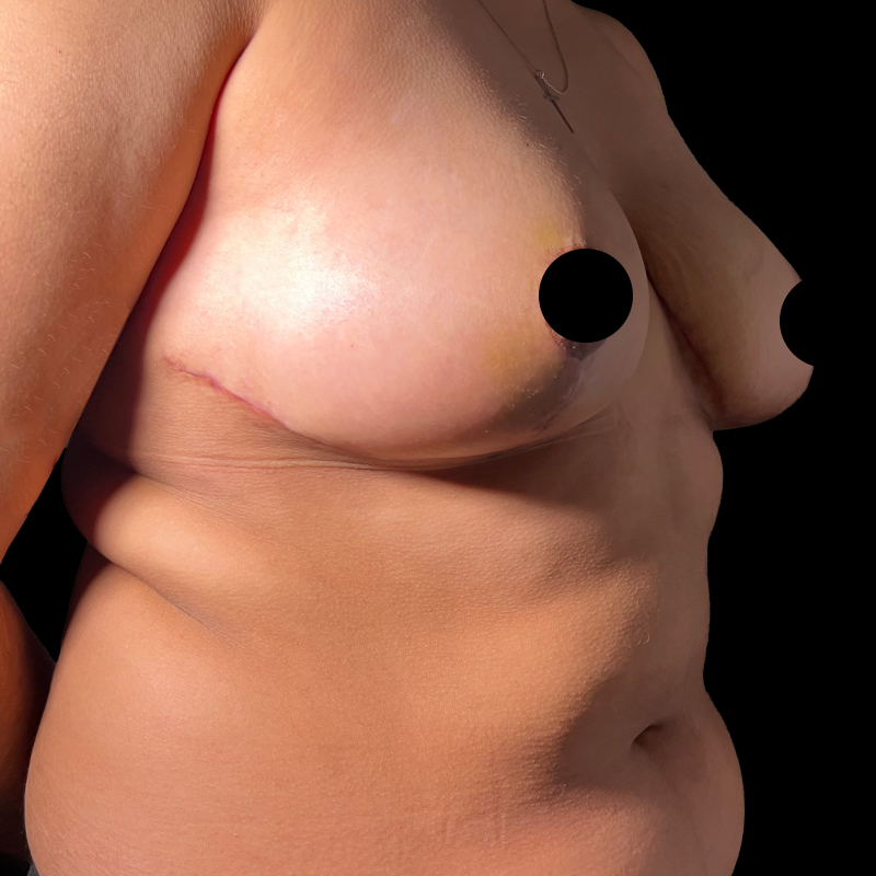 Breast Lift With Reduction 05