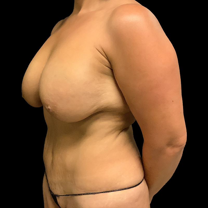 Breast Lift With Reduction 03
