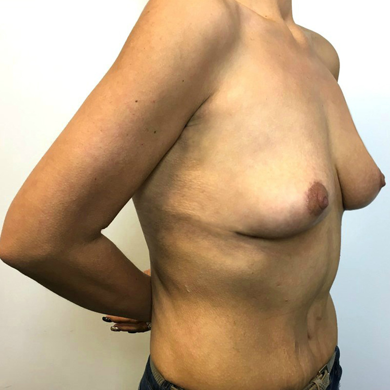 Breast Lift 03