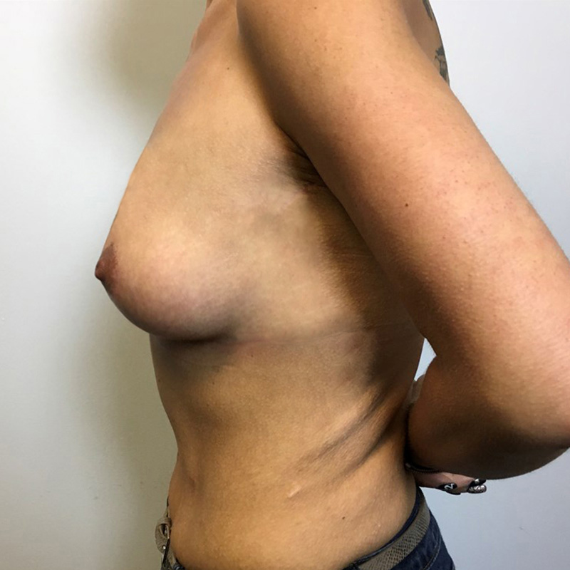 Breast Lift 09