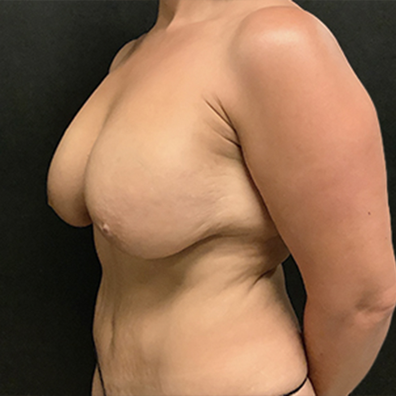 Breast Lift 03