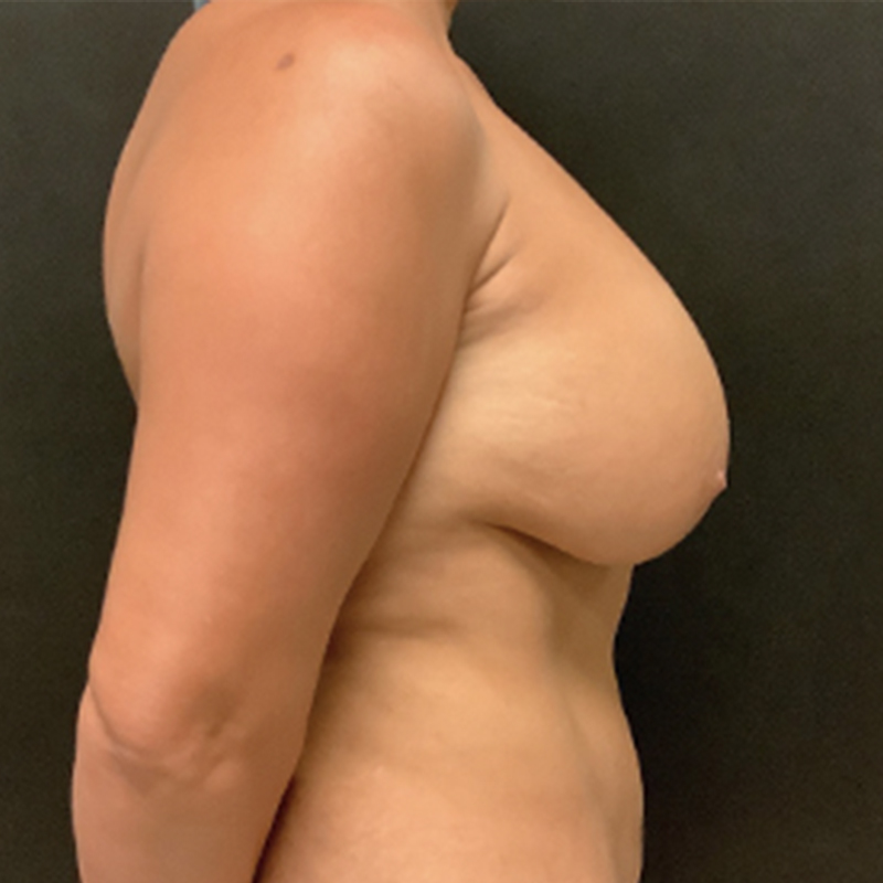 Breast Lift 09