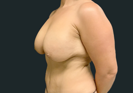 Breast Lift 01