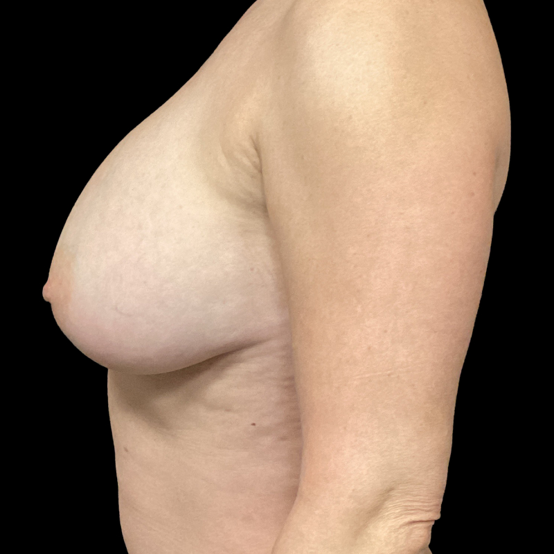 Breast Lift 03