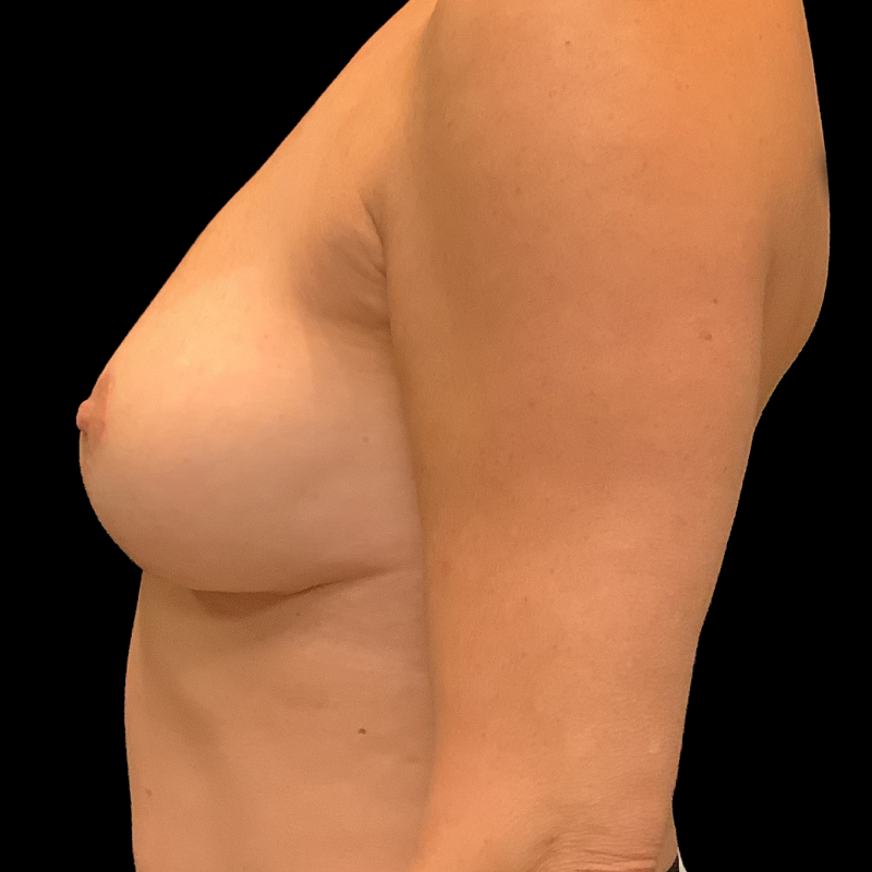 Breast Lift 03