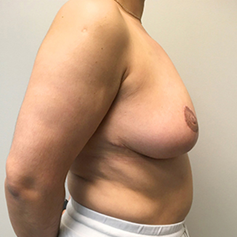 Breast Reduction 09