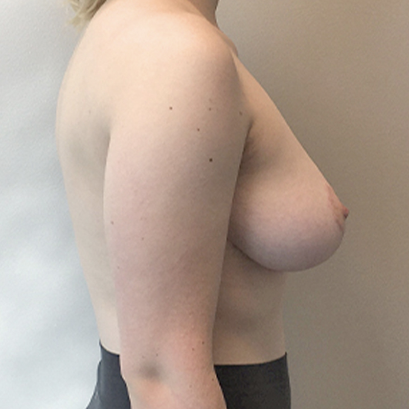 Breast Reduction 09