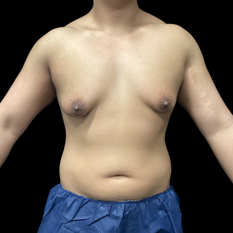Chest Reconstruction With Free Nipple Grafts 01