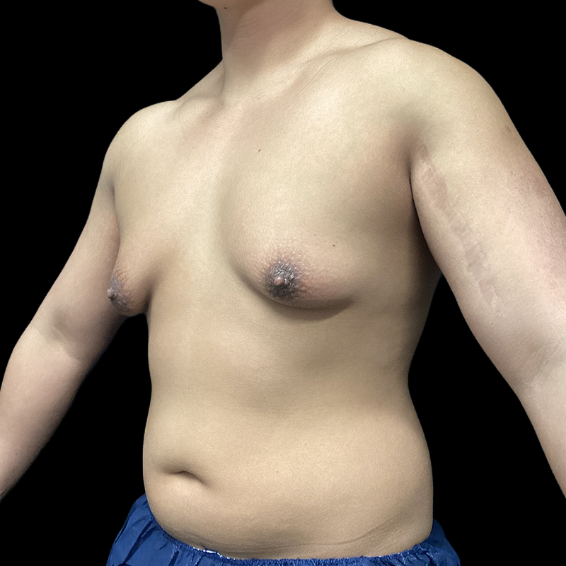 Chest Reconstruction With Free Nipple Grafts 03