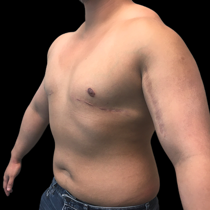 Chest Reconstruction With Free Nipple Grafts 03