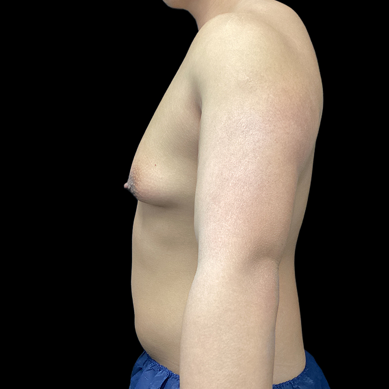 Chest Reconstruction With Free Nipple Grafts 05