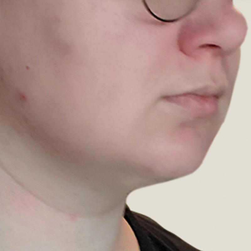 Chin Implant 03