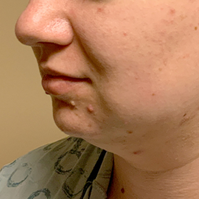 Chin Implant 07