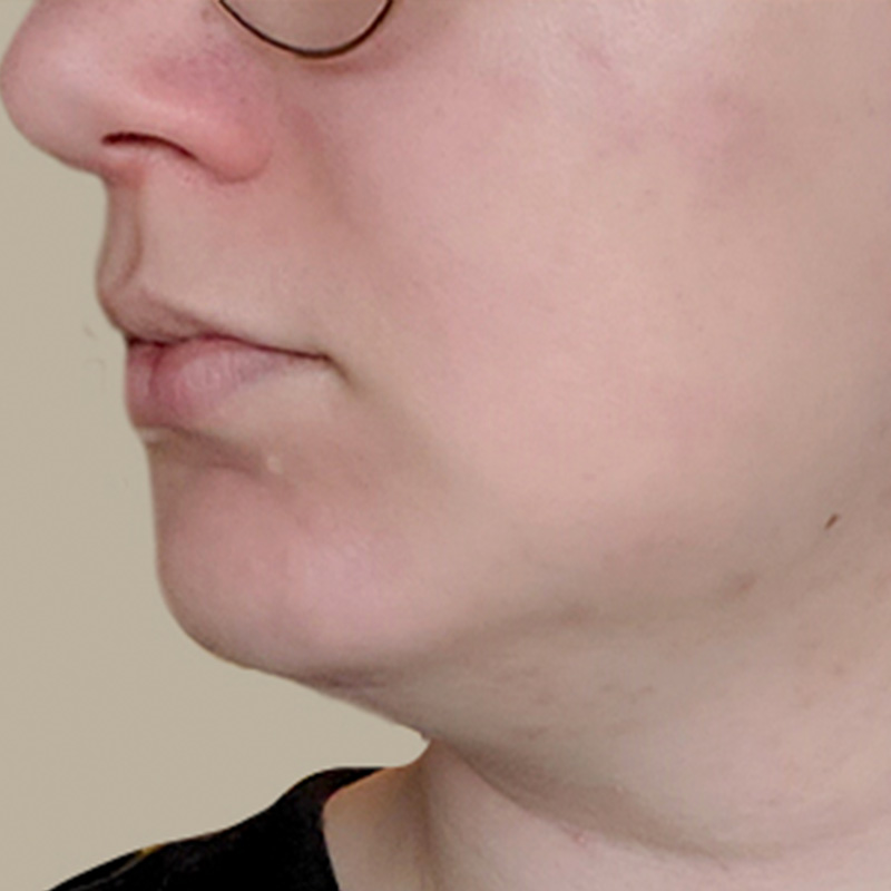 Chin Implant 07