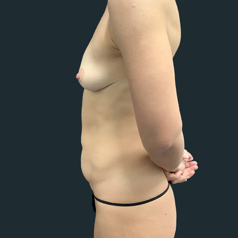 Extended Abdominoplasty 05