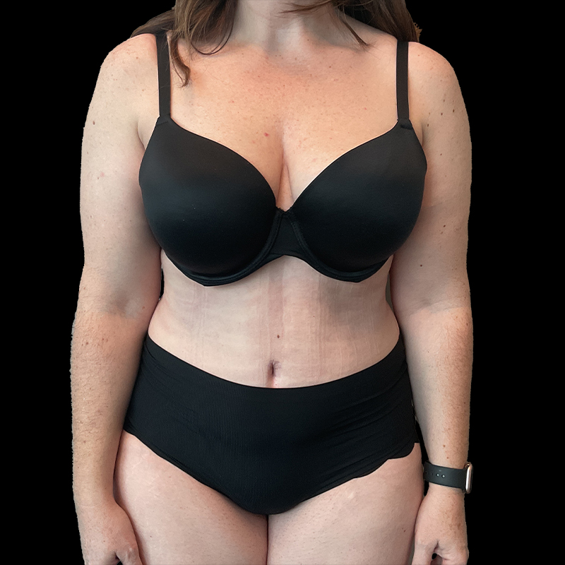 Extended Abdominoplasty 02