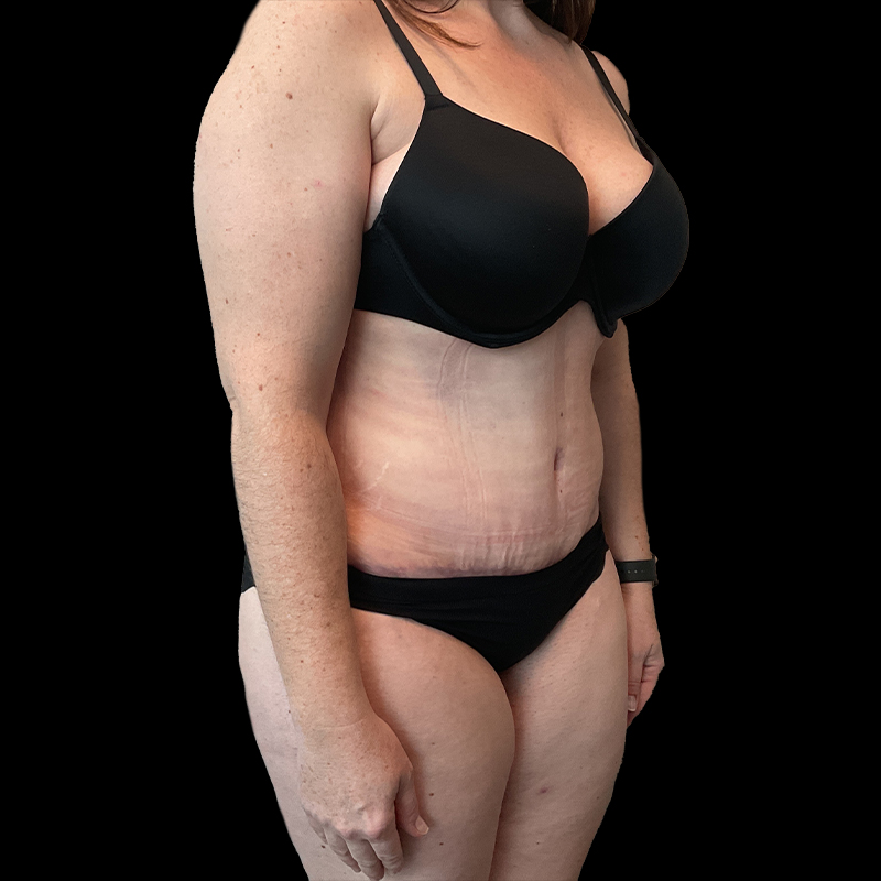 Extended Abdominoplasty 05