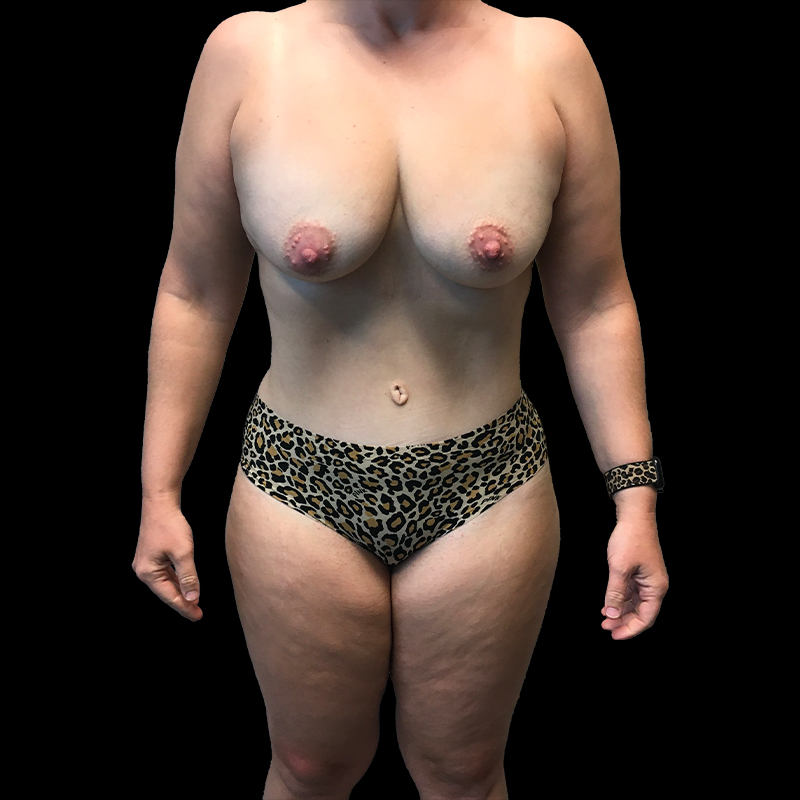 Extended Abdominoplasty 03