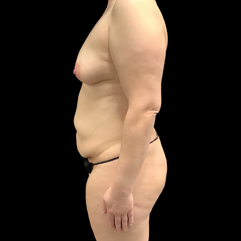 Extended Abdominoplasty 05