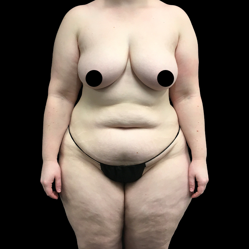 Extended Abdominoplasty 01
