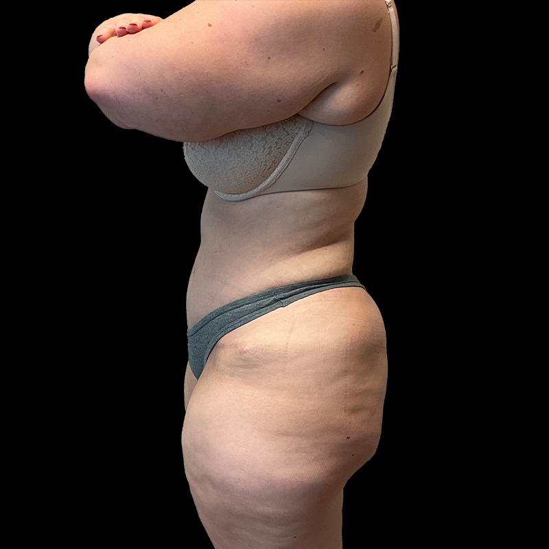 Extended Abdominoplasty 05