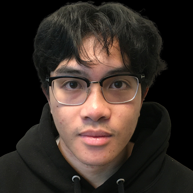 Extended Bilateral Otoplasty 01