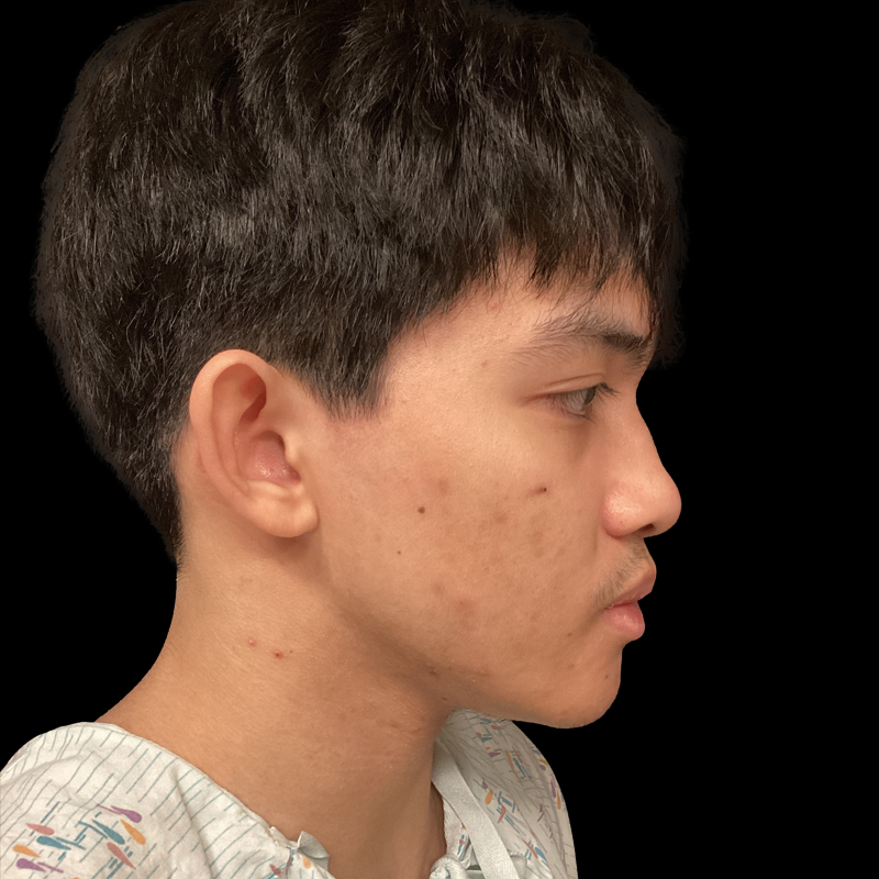 Extended Bilateral Otoplasty 03