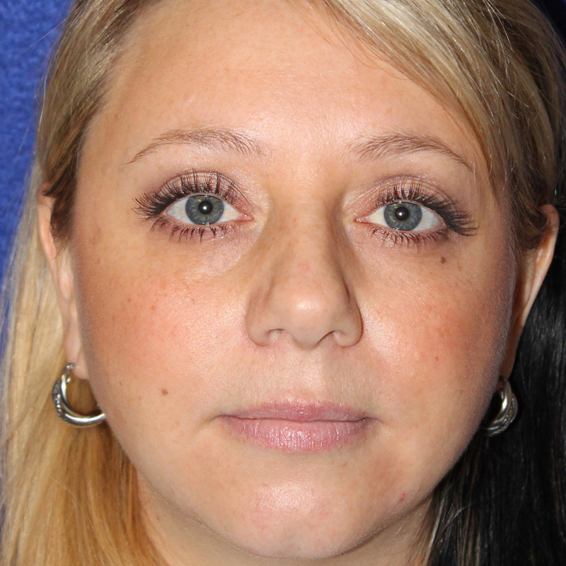 Facial Fat Transfer 01