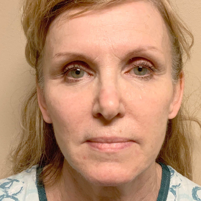 Facial Fat Transfer 01