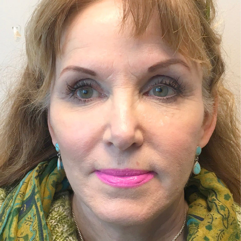 Facial Fat Transfer 02