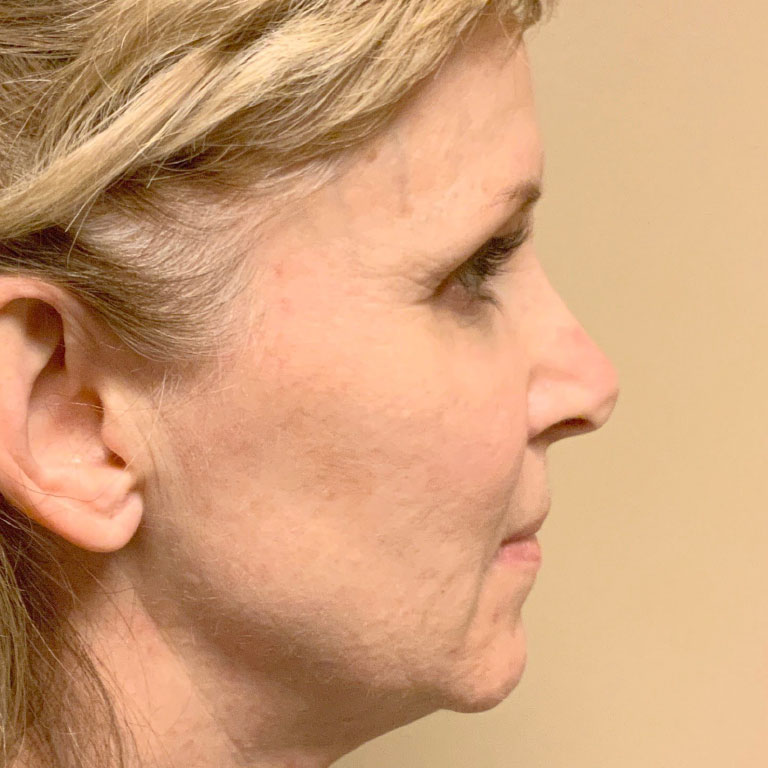 Facial Fat Transfer 03