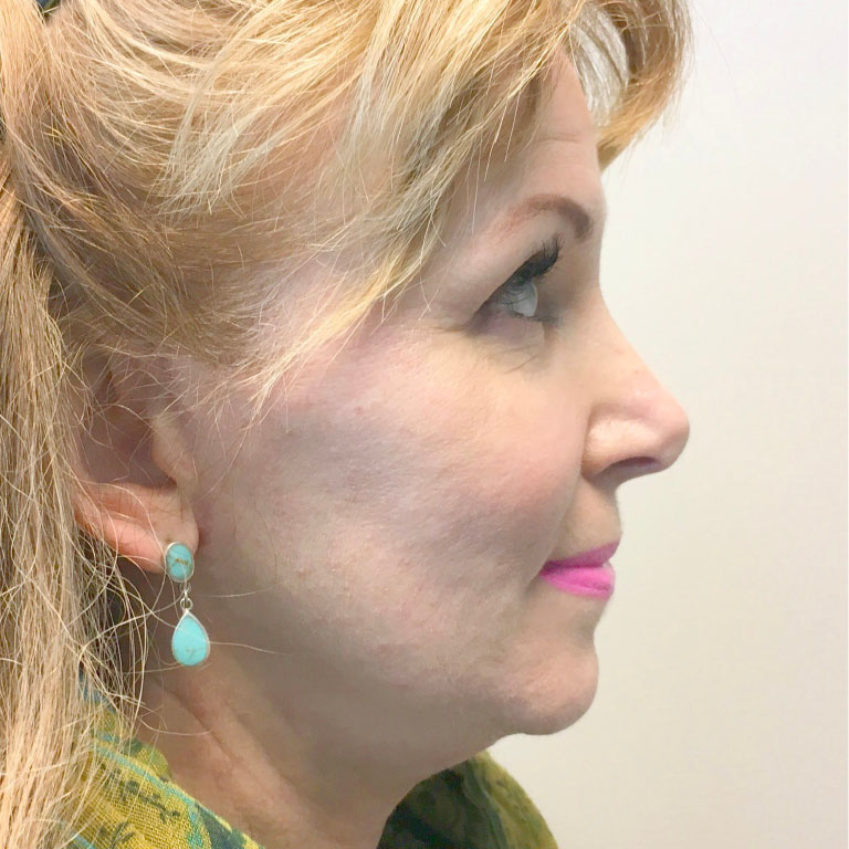 Facial Fat Transfer 03