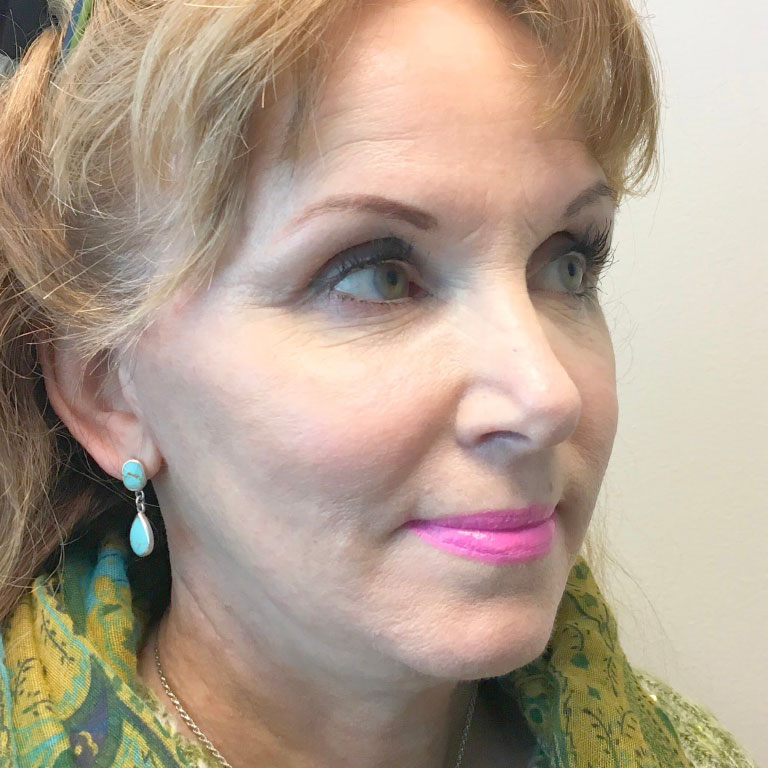 Facial Fat Transfer 05