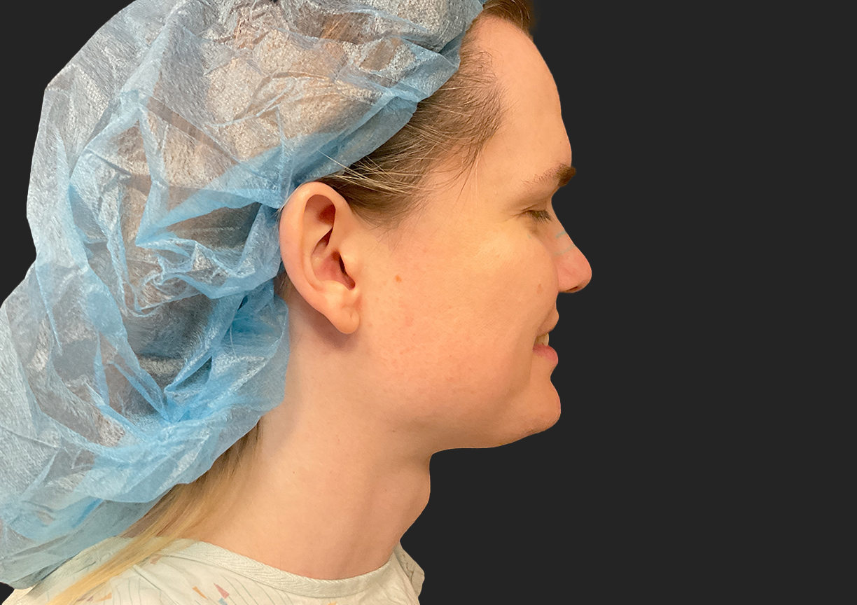 Facial Feminization 05