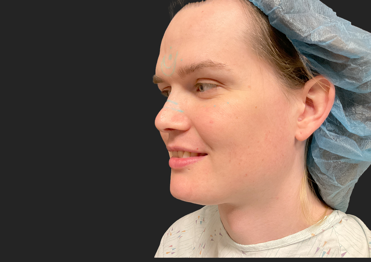 Facial Feminization 07