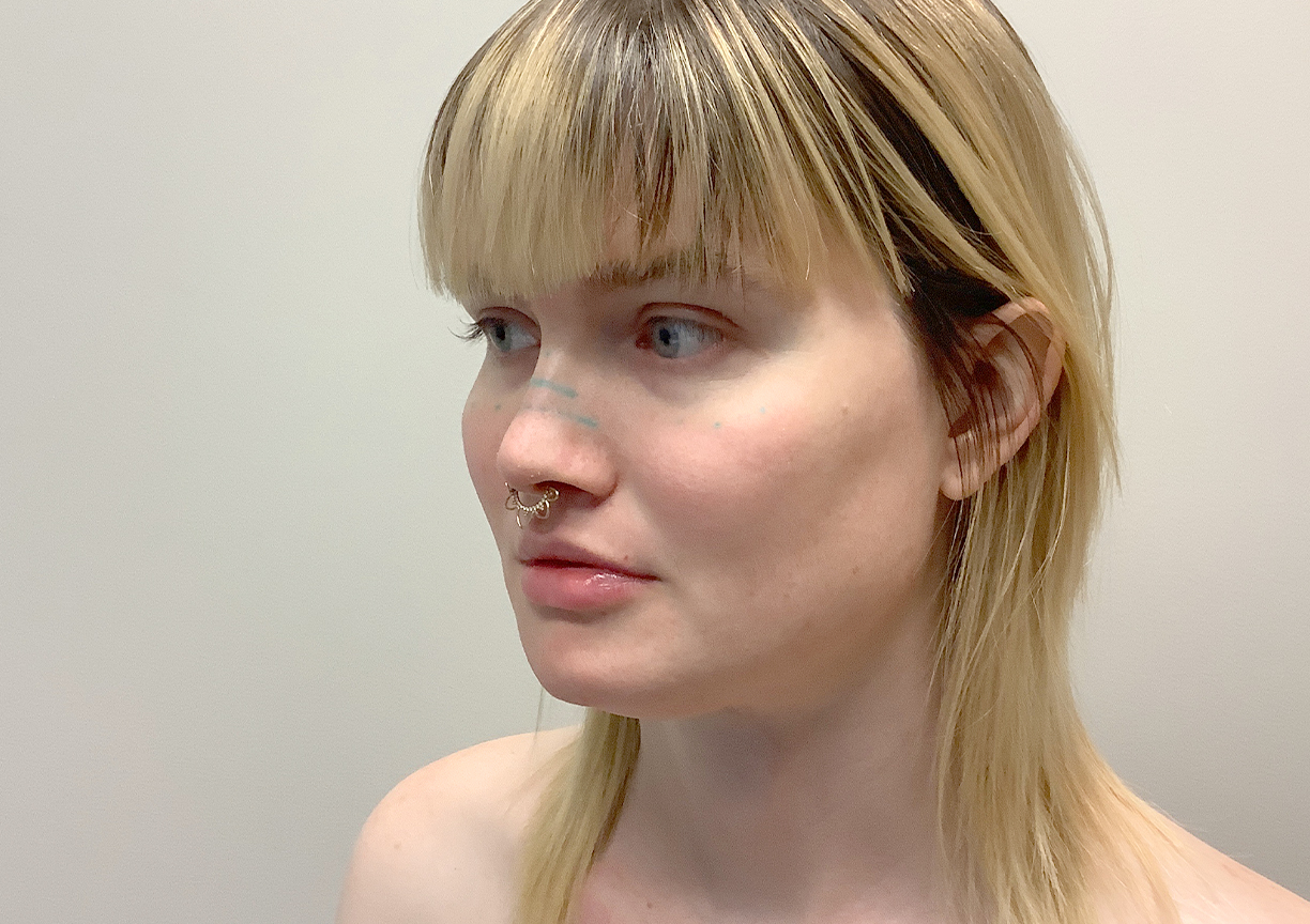 Facial Feminization 07