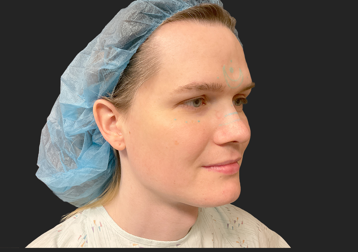 Facial Feminization 09