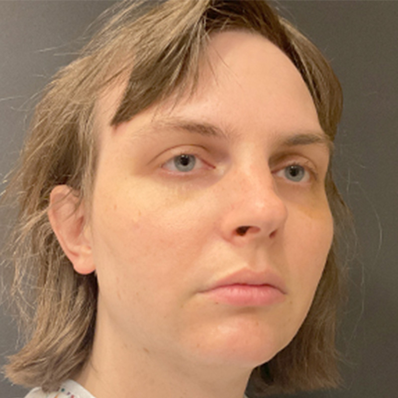 Facial Feminization 03