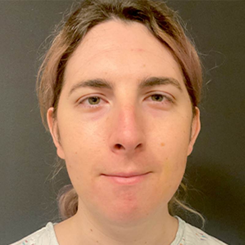 Facial Feminization 01