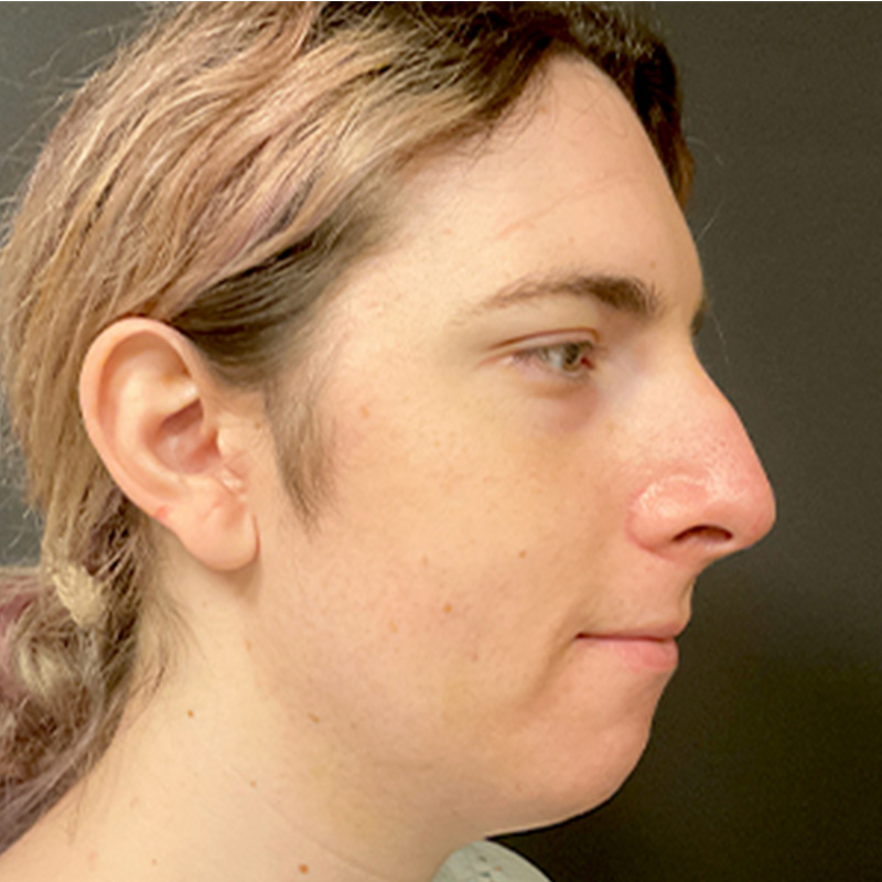 Facial Feminization 03