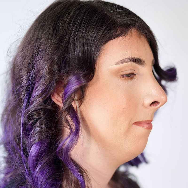 Facial Feminization 05