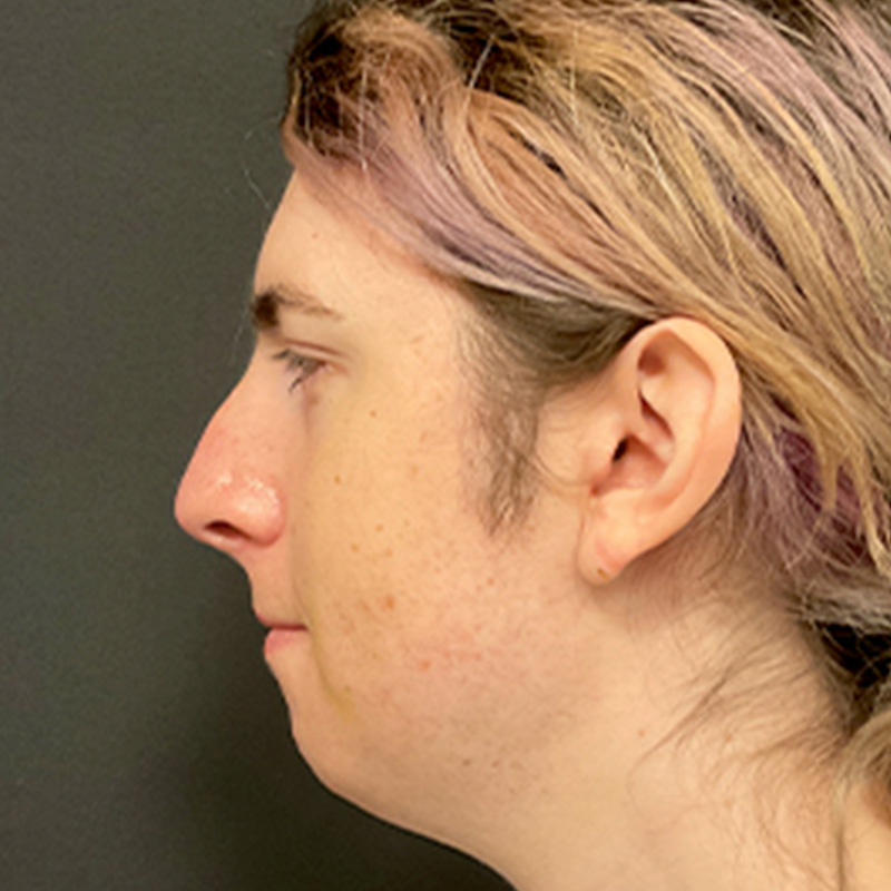 Facial Feminization 09