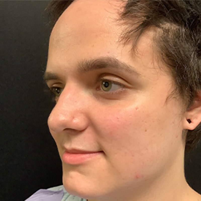 Facial Feminization 07