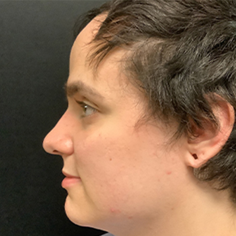 Facial Feminization 09